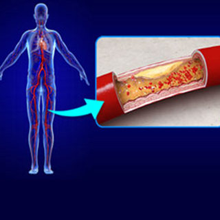 PERIPHERAL INTERVENTIONS