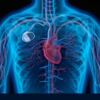 PACEMAKER IMPLANTATIONS