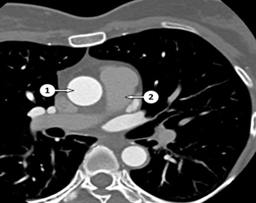 CT Coronary Angiography