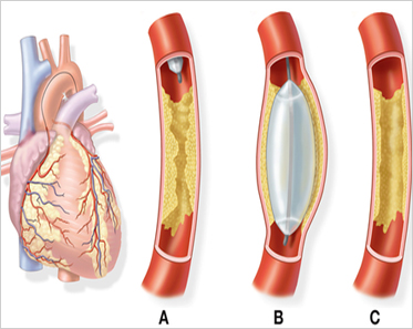 Angiography