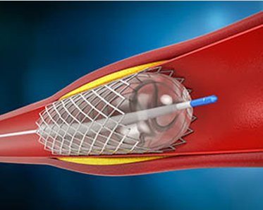 Angioplasty